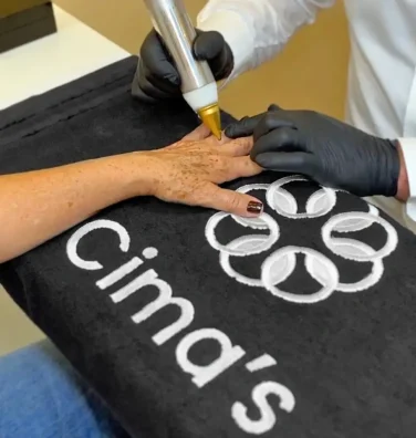 Um profissional aplicando o Método Cima’s em uma paciente. A imagem mostra uma mão de uma paciente repousando sobre uma toalha preta com o logotipo ‘Cima’s’. Um profissional, vestindo uma camisa branca e luvas pretas, está aplicando o tratamento usando um dispositivo portátil, em formato de caneta, com uma ponta dourada. O ambiente parece ser um local profissional, como uma clínica ou spa, devido à sua aparência limpa e organizada.