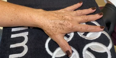 Mão feminina com manchas senis repousando sobre uma toalha preta com detalhes circulares brancos