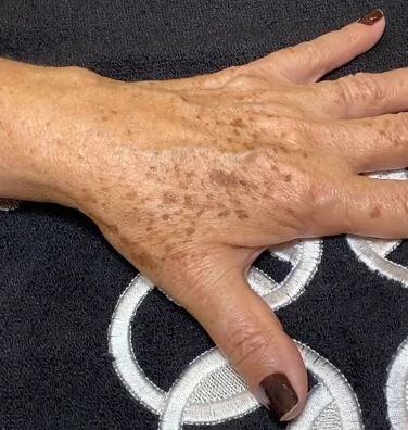 Mão feminina com manchas senis repousando sobre uma toalha preta com detalhes circulares brancos