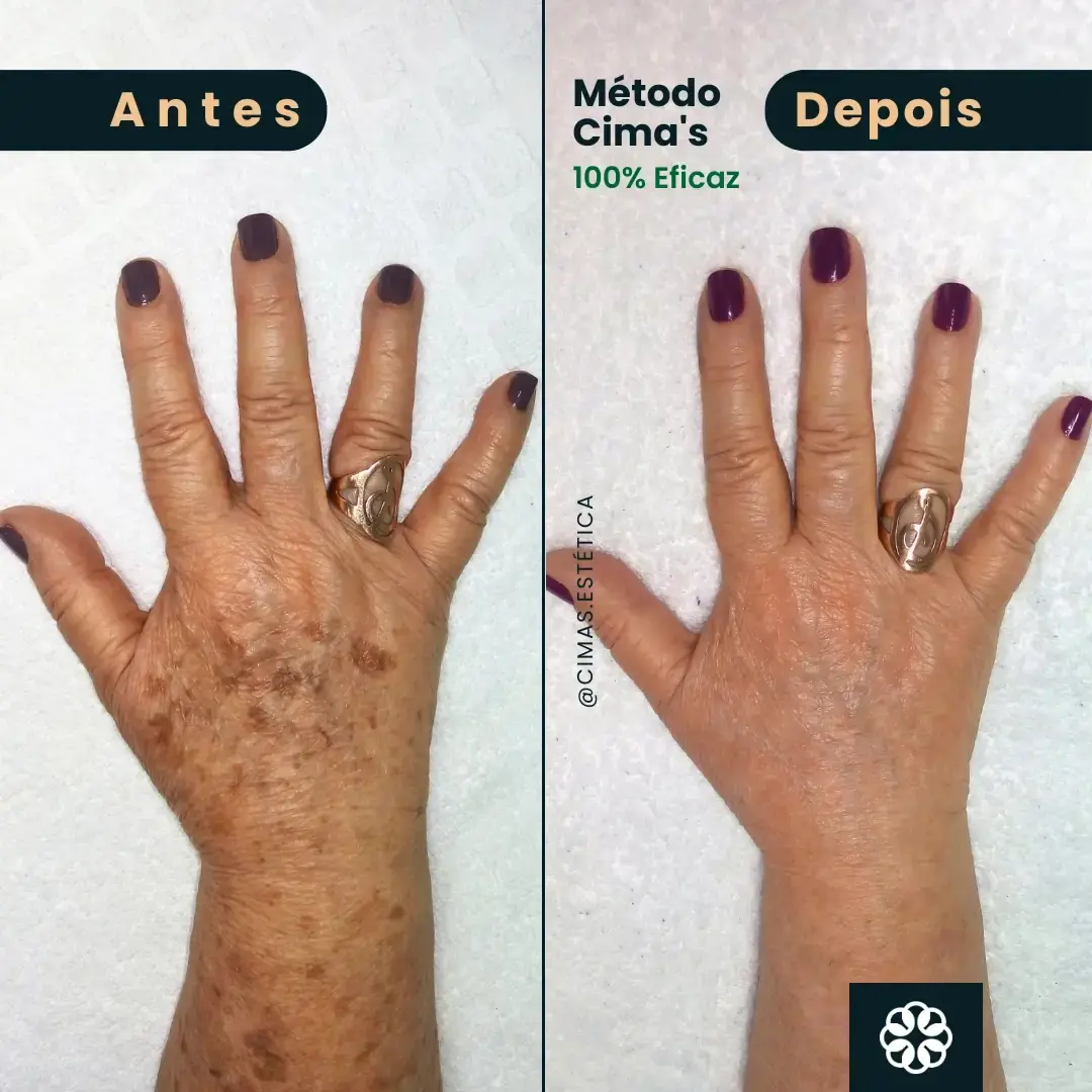 Antes e Depois do Método Cima's