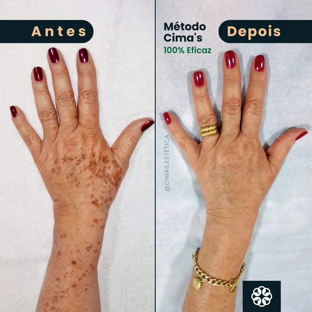 Antes e Depois do Método Cima's na mão