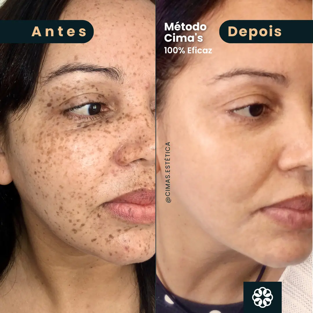 Antes e Depois do Método Cima's no Rosto