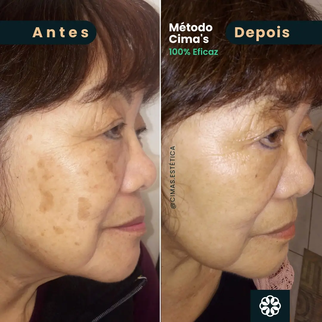 Antes e Depois do Método Cima's no rosto