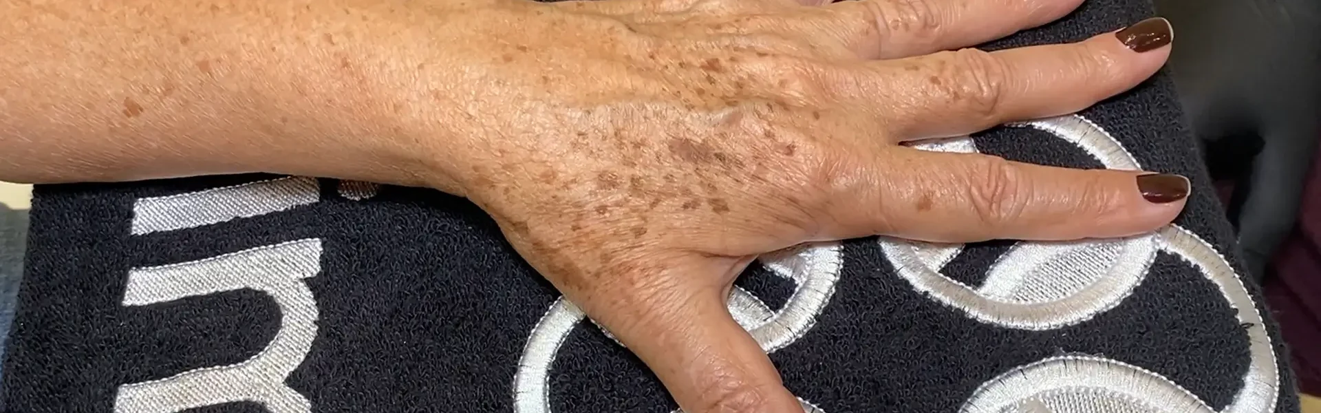 Mão feminina com manchas senis repousando sobre uma toalha preta com detalhes circulares brancos